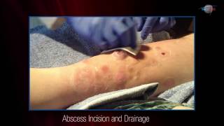 WCW Abscess Incision and Drainage [upl. by Frentz568]