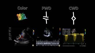 Spectral Doppler [upl. by Cassilda500]