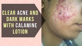 CLEAR ACNE AND DARK MARKS WITH CALAMINE LOTION [upl. by Alpheus]