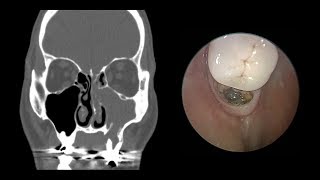 Study Sinus infection Skip antibiotics [upl. by Hsan]