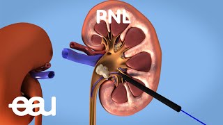 Behandlung von Nieren und Harnleitersteinen PNL [upl. by Rekrap361]