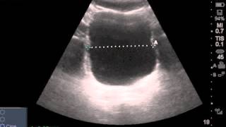 Ultrasound Estimated PostVoid Residual Bladder [upl. by Auj]