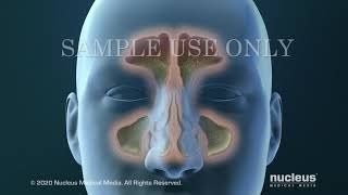 Sinusitis Surgery [upl. by Ahcire]