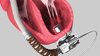 Medical Device Animation Heartware System LVAD Pump [upl. by Lleon35]