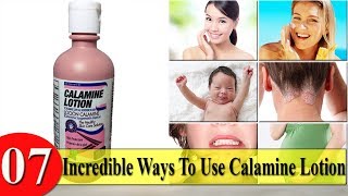 7 Incredible Ways To Use Calamine Lotion [upl. by Nam]