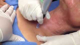 Dermapen video explaining procedure and showing procedure done [upl. by Broida]